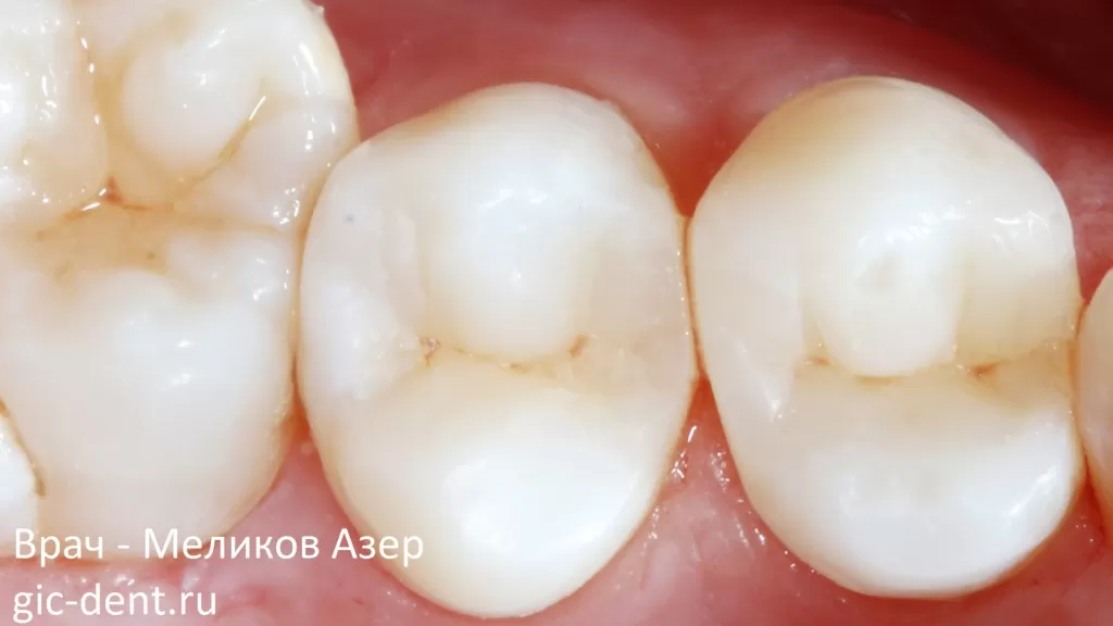 Восстановление зубов 4,5,6 эстетической реставрацией